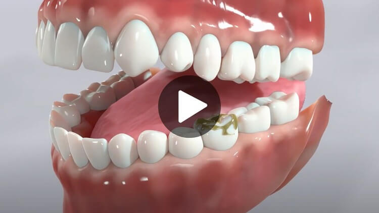 A thumbnail image for an educational videos about filling cavities