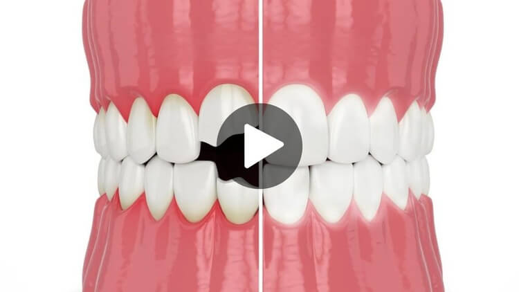 A thumbnail image for an educational videos about cosmetic dentistry