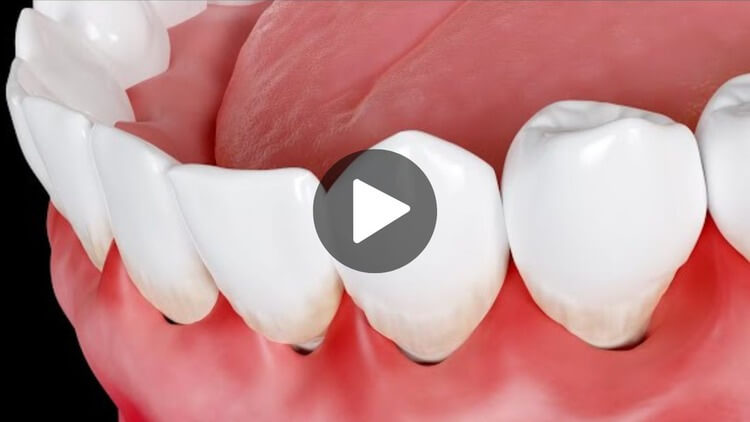 A thumbnail image for an educational videos about swollen gums